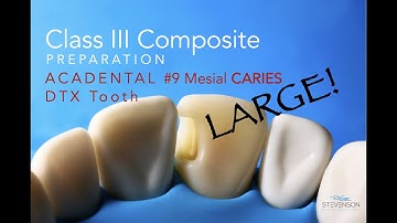Class III Composite Preparation - EXTENSIVE CARIES - DTX #9 Mesial by Acadental