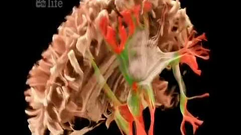 BBC Siemens 3D Neurological Brain Scan