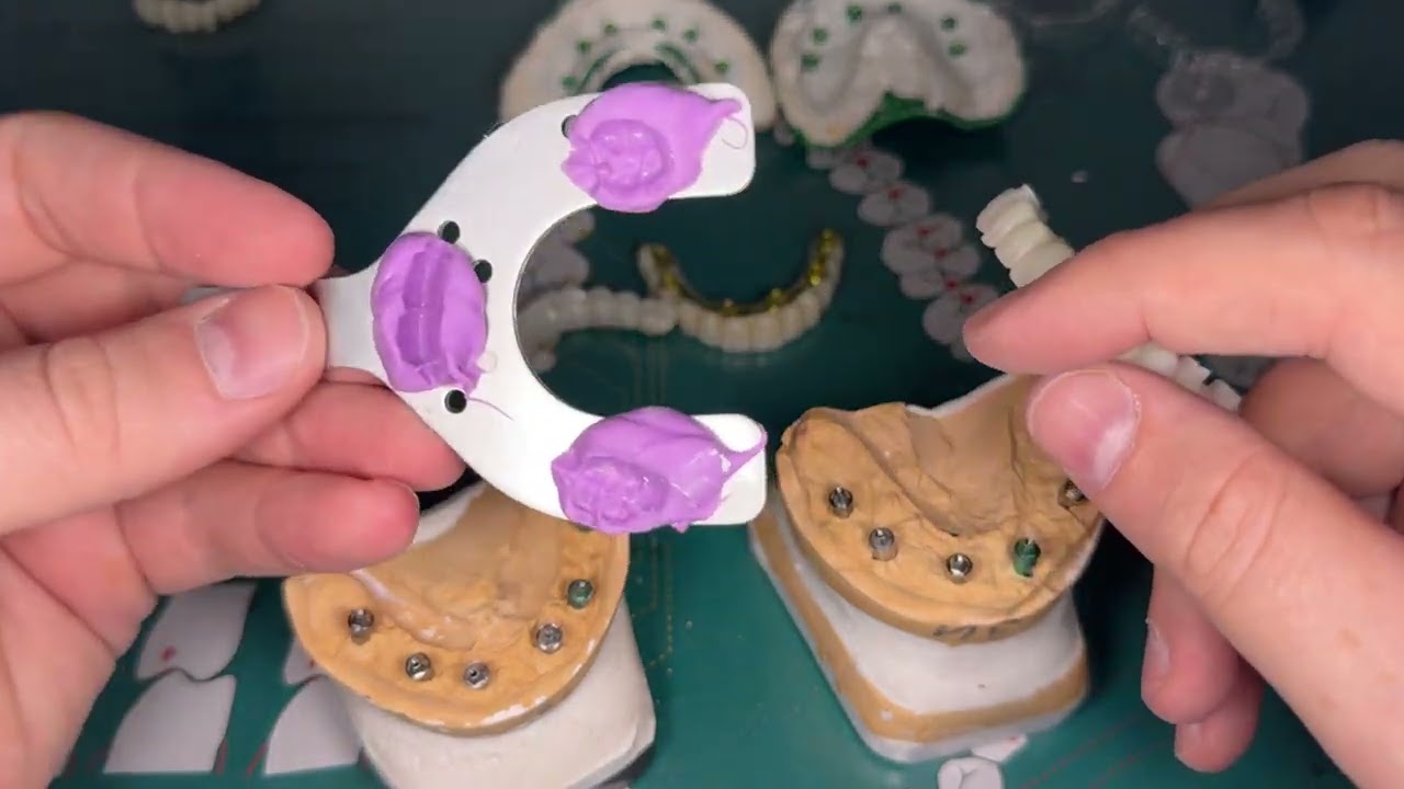 Циркониевые коронки с титановой балкой на мультиюнитах. Тотал.