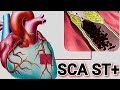 Syndrome coronarien aigu avec sus dcalage st  sca st 
