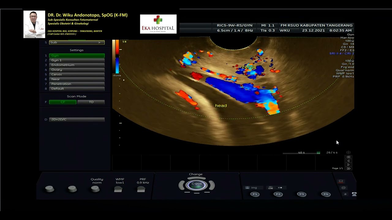 VASA PREVIA (Pembuluh Darah Menutupi Mulut Rahim - Dr. Wiku Andonotopo)