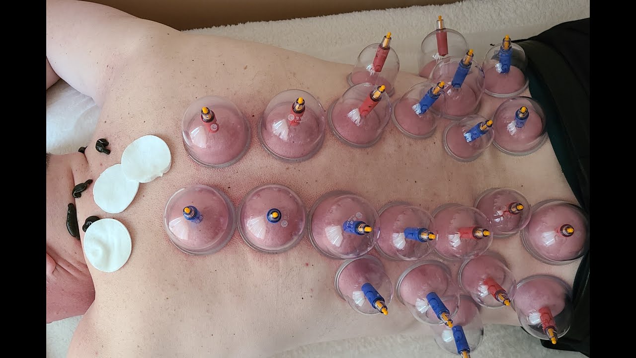 Лечение гипертонии пиявками