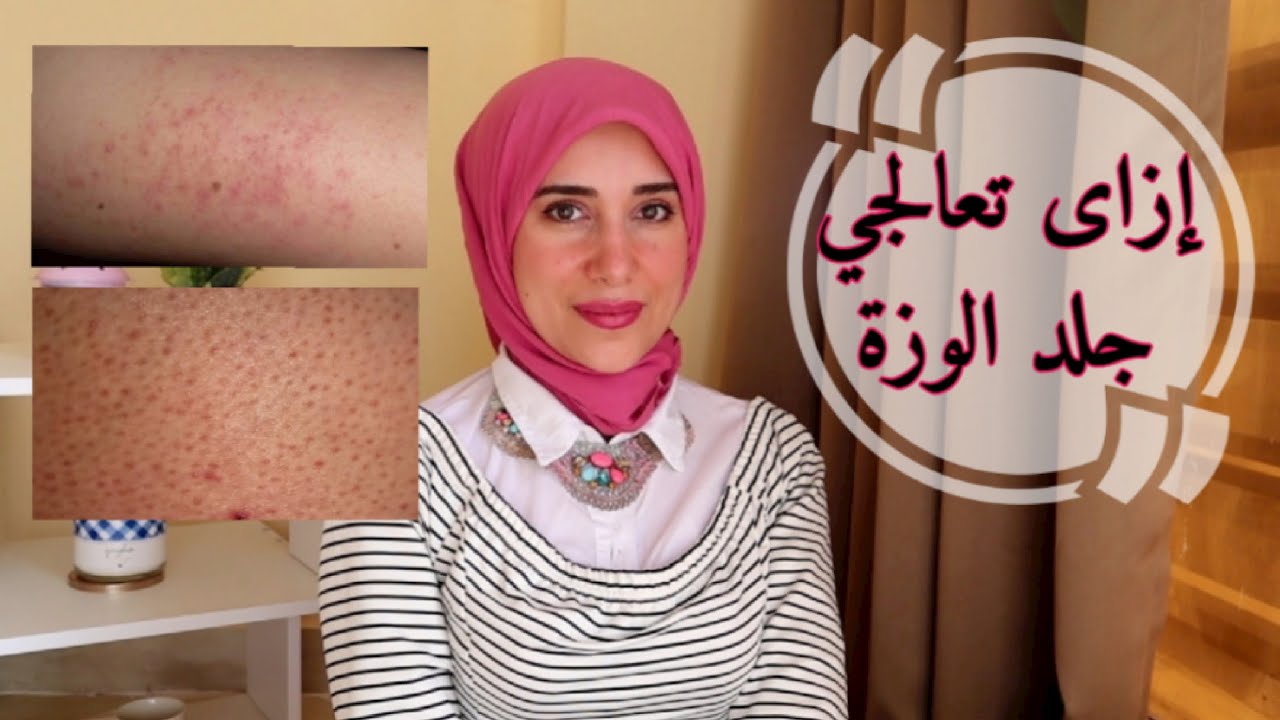 ازاى تتخلصي من جلد الوزة || نصائح لتجنب جلد الوزه|| أسباب جلد الوزه|| Keratosis pilaris