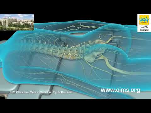 Lumbar Laminectomy (Hindi) - CIMS Hospital