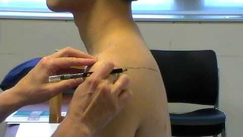 Surface Anatomy: Acromion Process