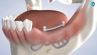 Specialty Implants at North Jersey Oral &amp; Maxillofacial Surgery, Teaneck, NJ