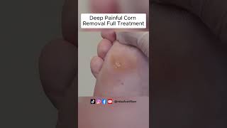 Satisfying Deep Painful Corn Removal Full Treatment By Miss Foot Fixer