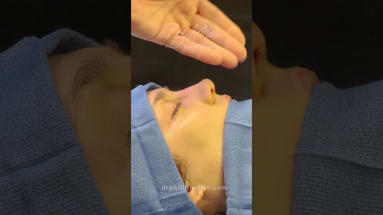 Immediate Rhinoplasty Results! NatraNose By Dr. Philip Miller In NYC and NOLA