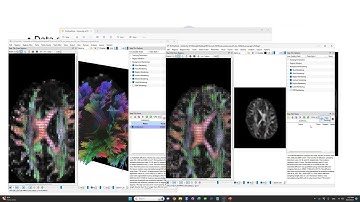 DTI vs GQI in tumor presurgical planning. Why you should consider using a more advanced model.