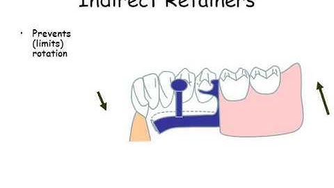 Indirect retainer for the removable partial denture