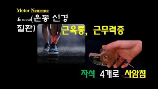 0840: 운동 신경 질환, 근육통, 근무력증- 자석 4개로 사암침
