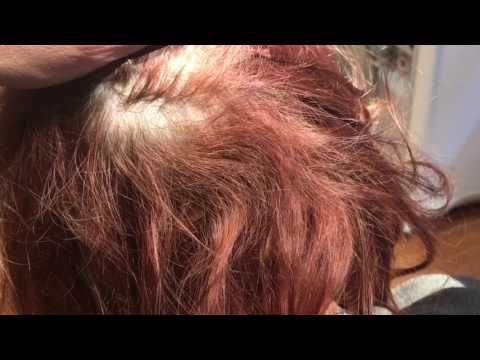 HD Close-Up of Donor Incision after Female Hairline Hair Transplant