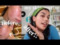 How I Cleared My Acne, skincare routine & tips!!