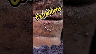 BE ON THE LOOK OUT FOR LONGER EXTRACTION VIDEO! HERE IS A TASTE! 💪🏾 #acne #skincare #extraction