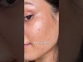 Botox offer