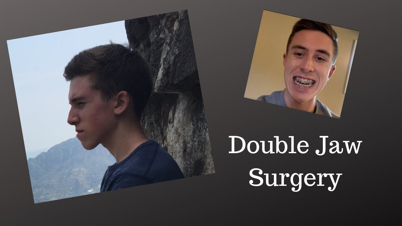 Double Jaw Surgery & Genioplasty PRE OP YouTube