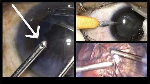 Learn the technique of  Irrigation aspiration - Part 1 -Bimanual I/A - an instructional video