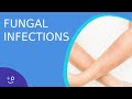 Fungal Infections - Causes, Prevention and Cure