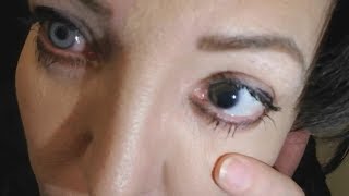 BRIGHTOCULAR GONE WRONG - PATIENT DISCUSSES BAD EXPERIENCE WITH BRIGHTOCULAR IRIS IMPLANTS