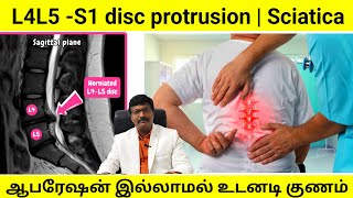 L4L5 -S1 disc protrusion | Sciatica |ஆபரேஷன் இல்லாமல் உடனடியாக குணம் #Best physiotherapy solutions
