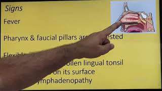 Lingual Tonsillitis English Patient Teaching Programme