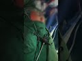 Advanced Laparoscopic Appendectomy at Sayee Speciality Hospital