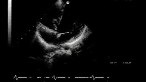 perimembranous VSD with aneurysm of the membranous septum