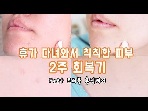 휴가다녀와서 칙칙해진 피부 2주 회복 프로젝트 <strong>여드름</strong> <strong>흉터</strong> <strong>없애는</strong> <strong>방법</strong>