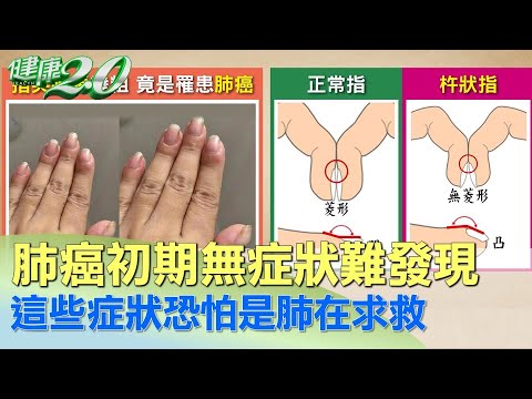 【名醫觀點】陳文茜發現肺癌因為「容易喘」！4個你想不到的症狀 也跟肺癌有關