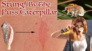 STUNG! By the PUSS CATERPILLAR in North Carolina - United States Most Venomous Caterpillar!* Black Caterpillar North Carolina