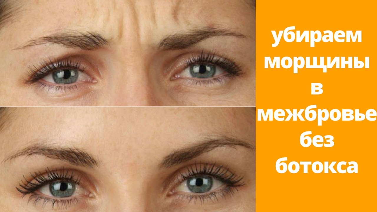 Как убрать межбровку без ботокса. Уколы ботокса в межбровку. Ботокс в межбровную складку. Как убрать межбровку без ботокса. Межбровка как убрать массажем фото.