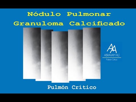 Vídeo: Granuloma Calcificado: En Pulmón, Tratamiento, Más