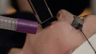 Pixel Peel Treatment Video