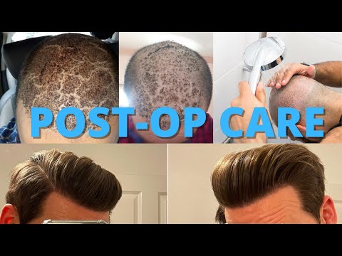 Hair Transplant Post-Op Care 101 (How To Wash Your Hair After Surgery)