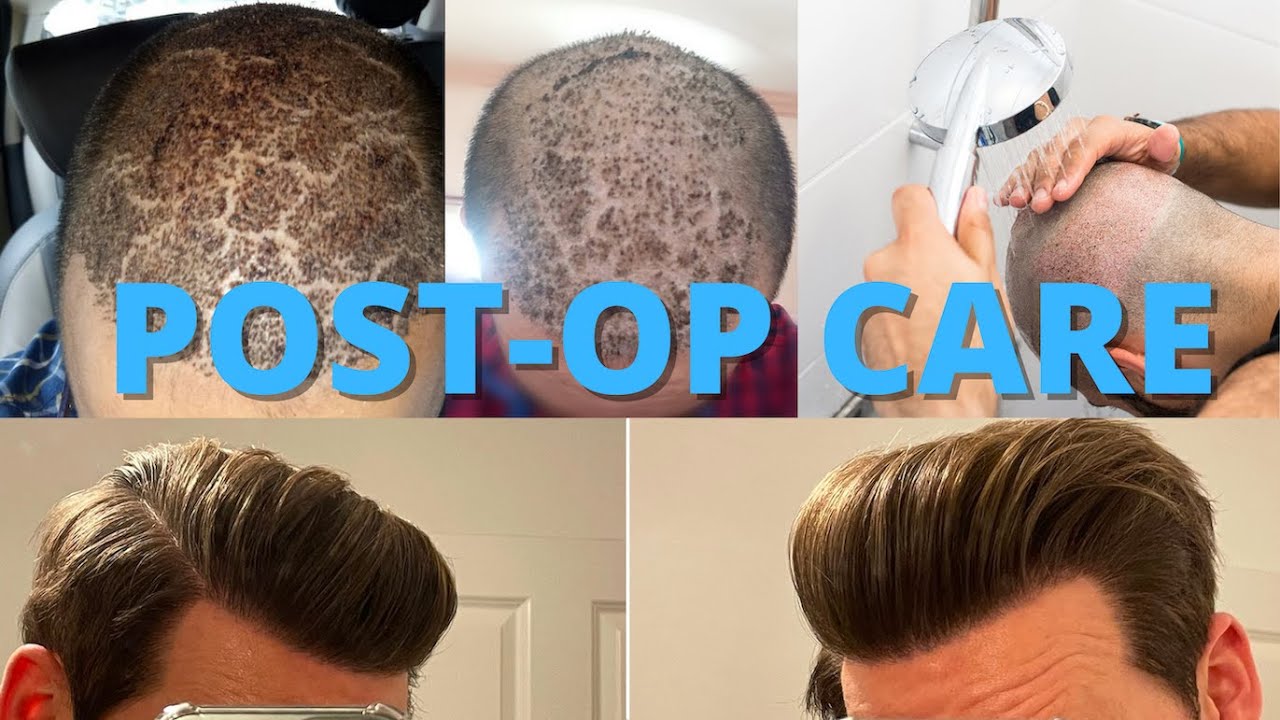 Hair Transplant Post-Op Care 101 (How To Wash Your Hair After Surgery) -  YouTube