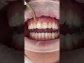 How it&rsquo;s done: non surgical gum lift/gum contouring. #ruhdental #dentist #smiledentist #newsmile