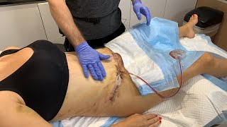 LYMPHATIC MASSAGE TO HEAL QUICKLY AFTER TUMMY TUCK   MOMMY MAKE OVER   FEMALE LIPO | DR. JASON EMER