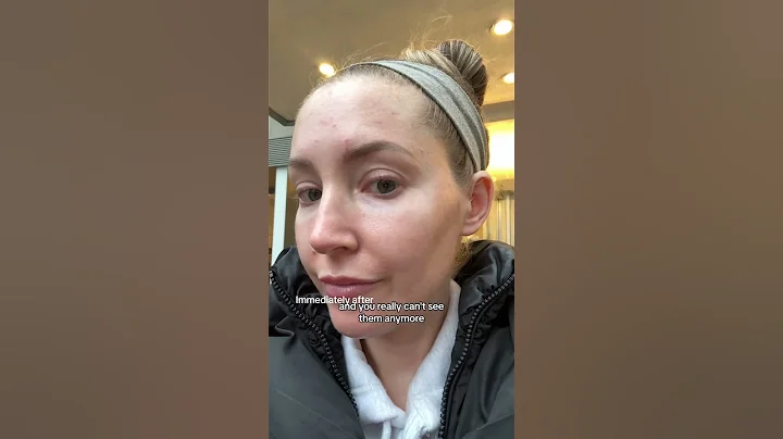 Sebaceous Hyperplasia Treatment