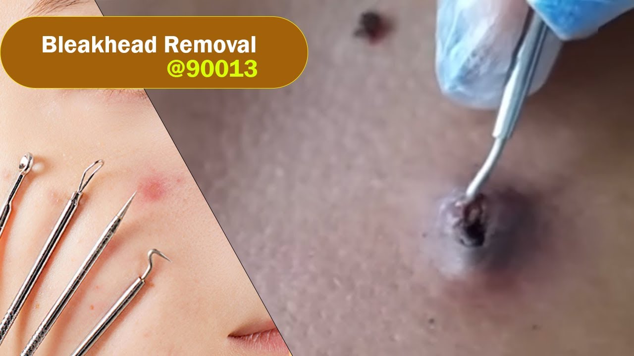 Big Blackhead Removal , extraction blackhead removal 900013 YouTube