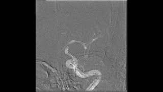 How to Avoid Exchange for Intracranial Stenting: Onyx Resolute Stent