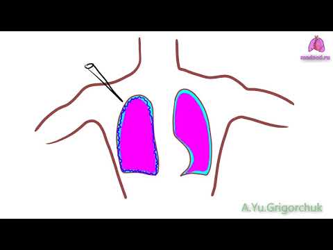 Видео: Хемоторакс: симптоми, лечение, причини