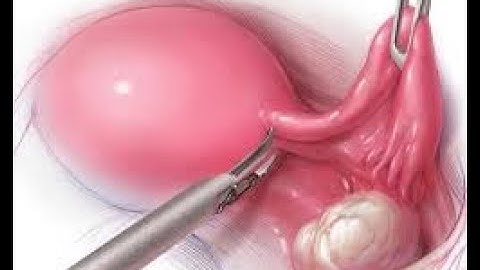 Oophorectomy CPT codes - simplify medical coding