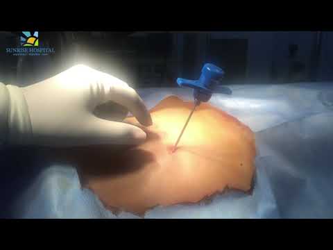 Treatment of Stem Cell | Stem cell Being Harvested