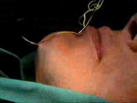 www.drserdev.com This is a video is about effect of chin enhancement using the Serdev suture technique, no scar, no downtime. Serdev suture is fixation of th...