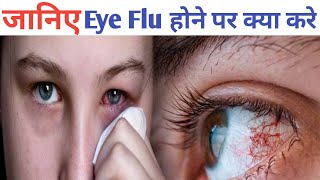 जानिए आई फ्लू होने पर क्या करे eye flu se kaise bache eye flu ke lakshan eye flu kaise hota hai