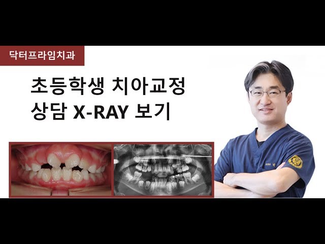 [치아교정]혼합치열기 x-ray