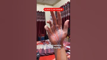 My Ulnar Nerve got compressed and this happened..😨🤯 Ulnar Claw Hand | Raj Bhosle #medical
