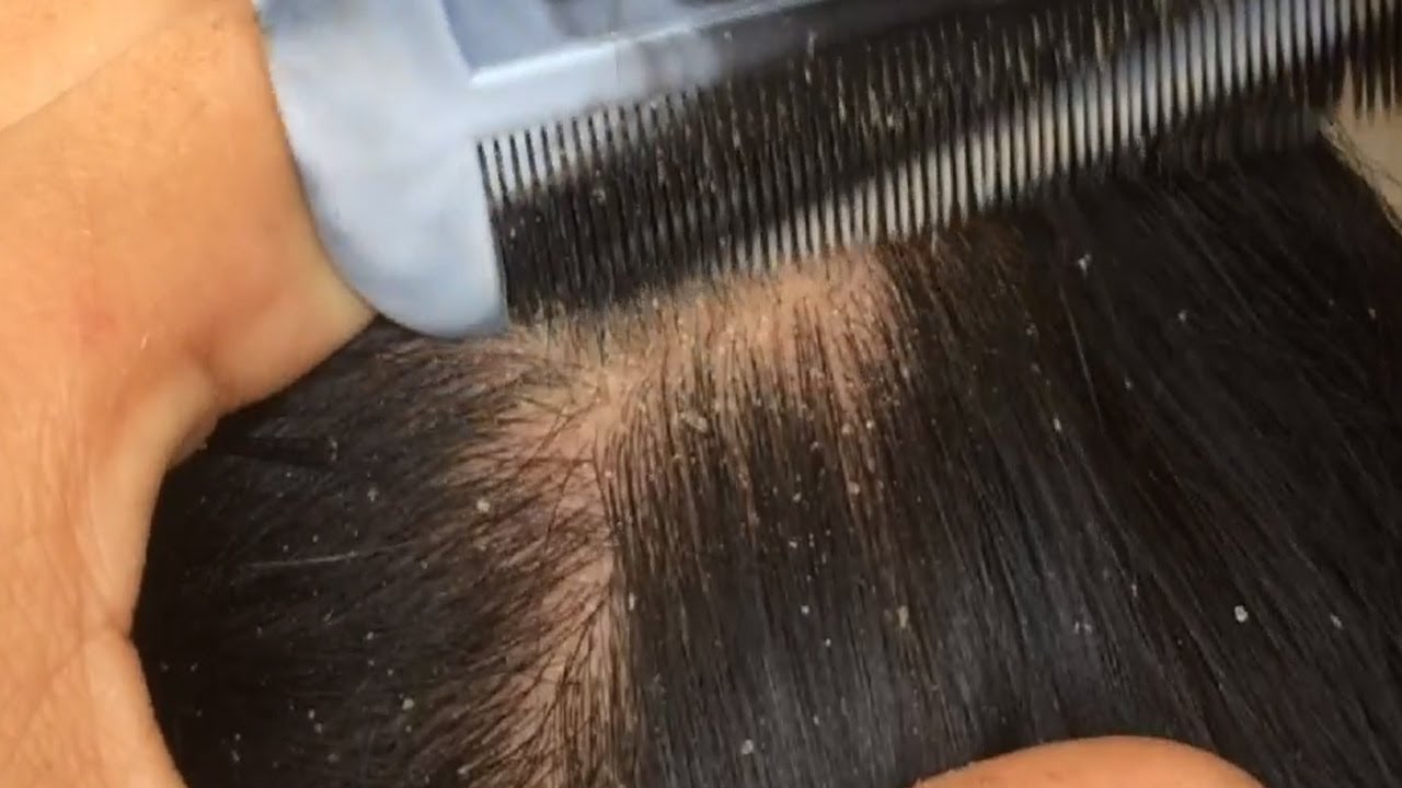 Dandruff Removal / Dandruff Extreme / Dandruff Scratching ASMR