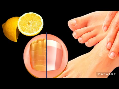100 НИКАКОГО ГРИБКА НА НОГТЯХ! 🍋НАТУРАЛЬНАЯ ТЕРАПИЯ для ЗДОРОВЫХ и БЛЕСТЯЩИХ НОГТЕЙ