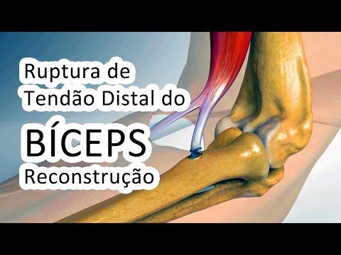 Vídeo: O que é cirurgia de bíceps?